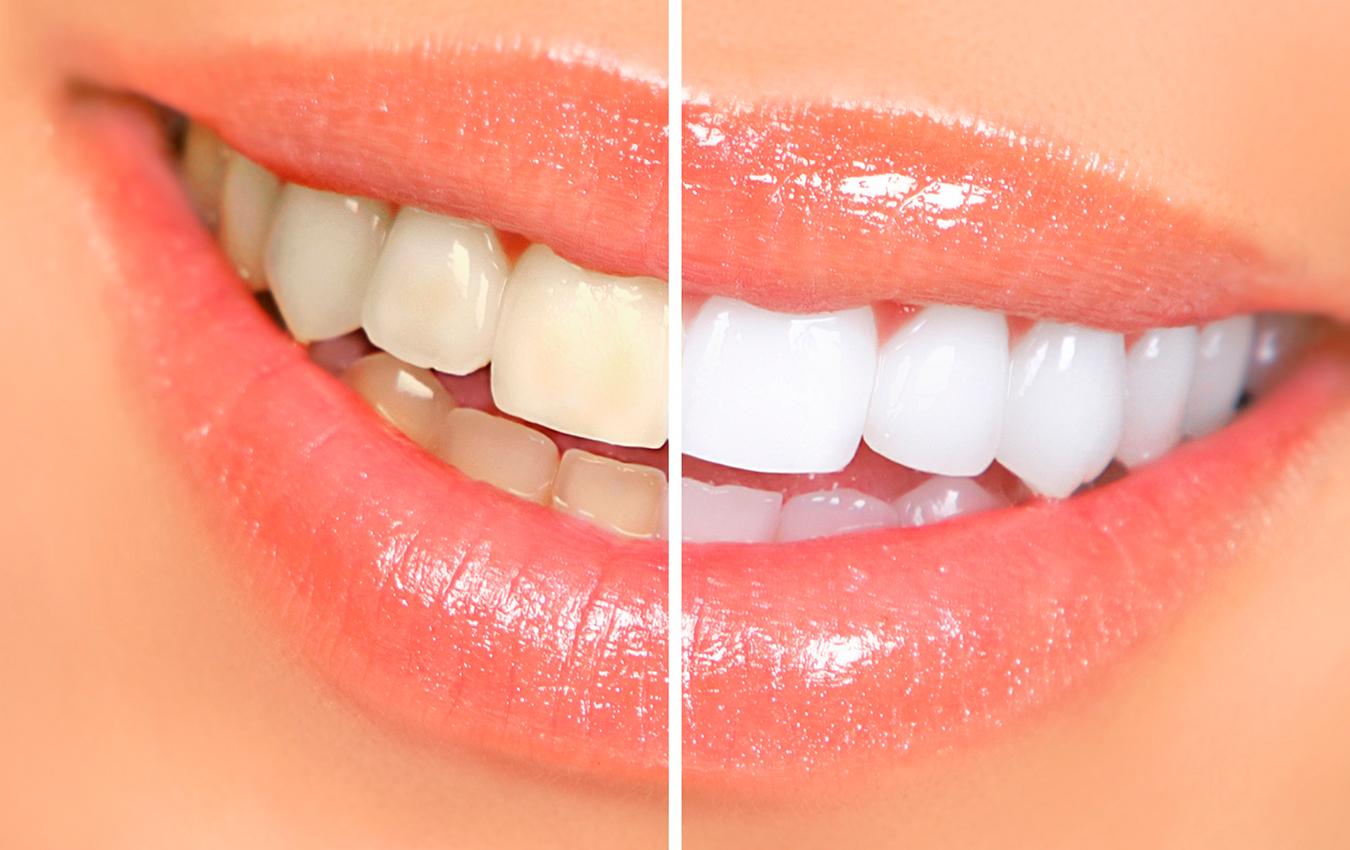 Bleaching – Whitening of Your Teeth