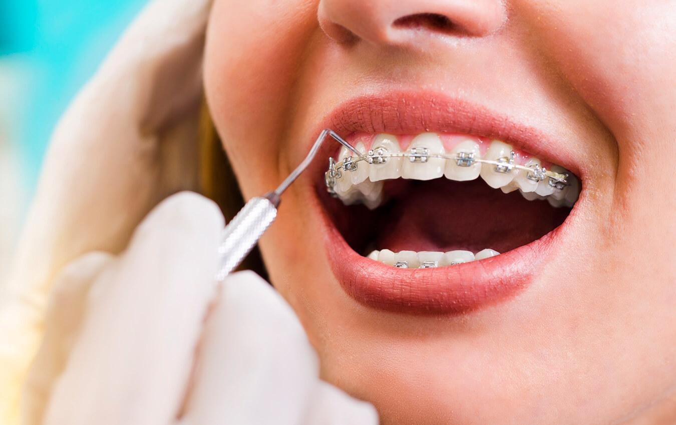 Braces and Retainers