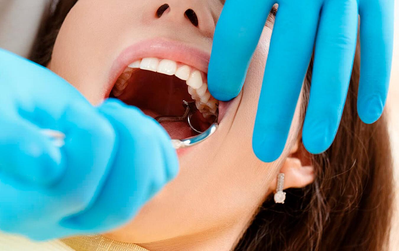 Care of Your Mouth After Wisdom Teeth Are Removed
