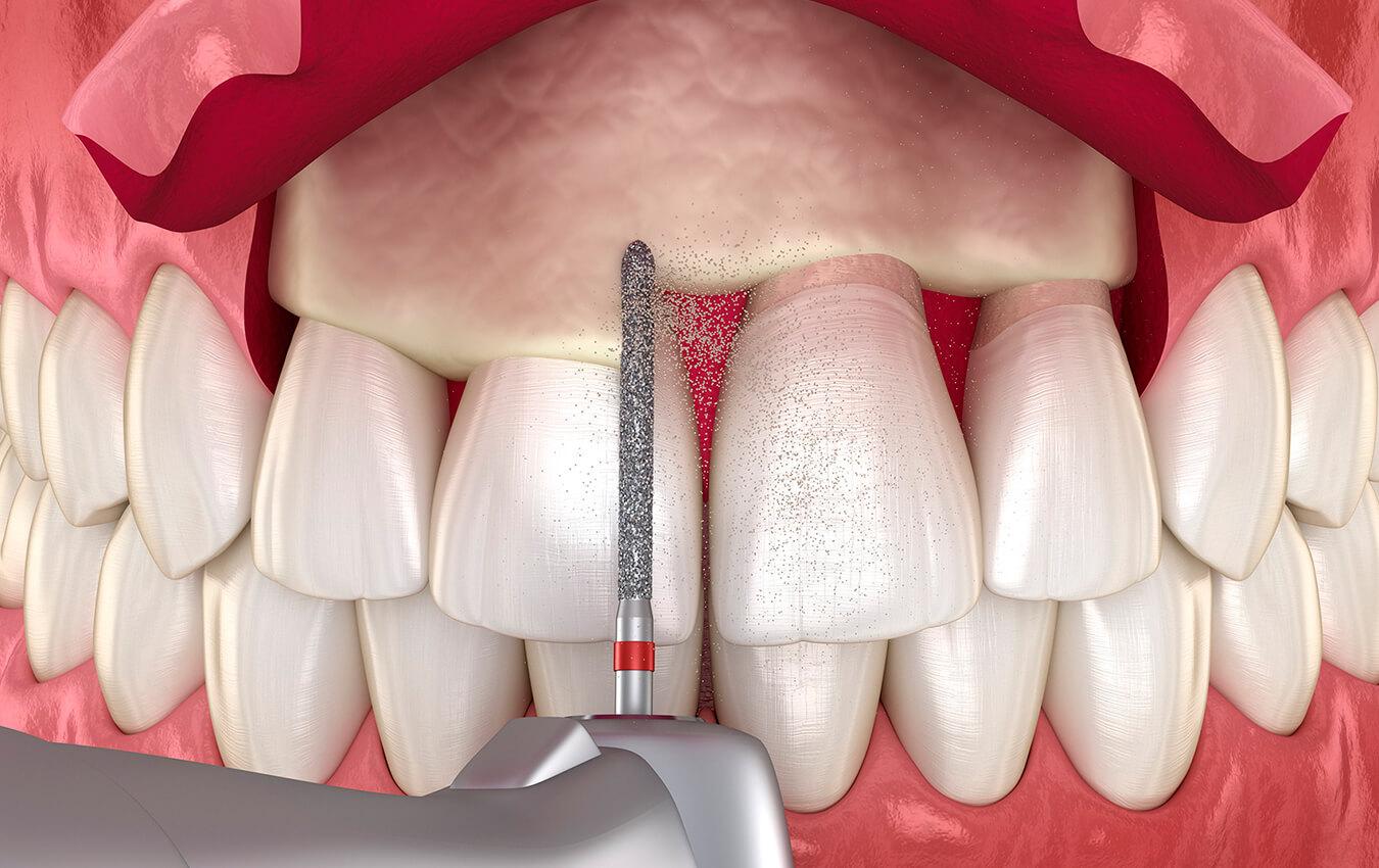 Crown Lengthening
