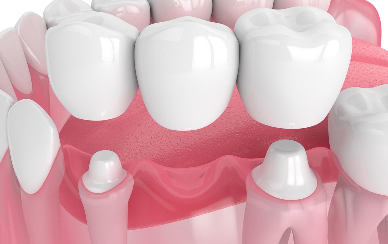 Dental Bridges … Filling In The Gaps
