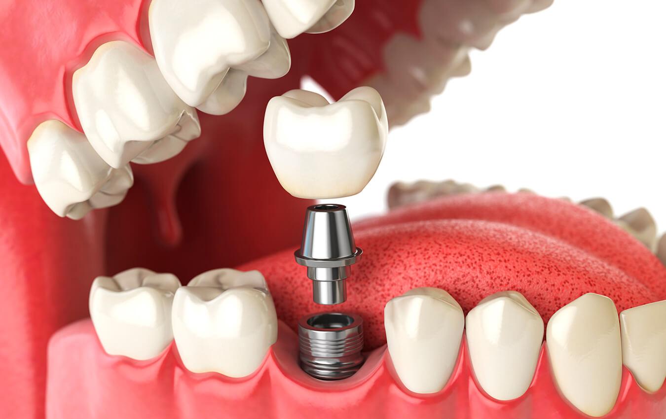 Dental Sealants