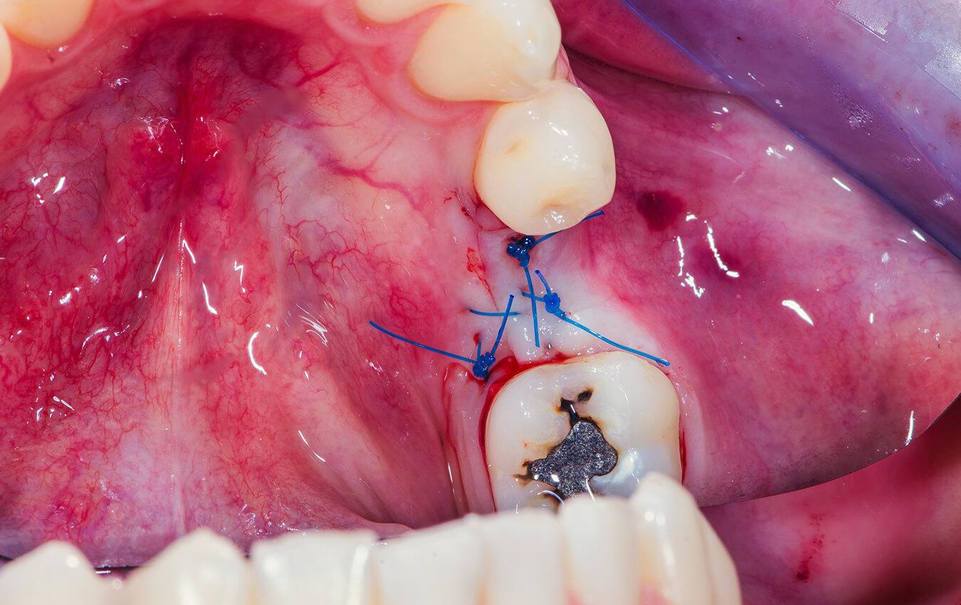 Endodontic Microsurgery