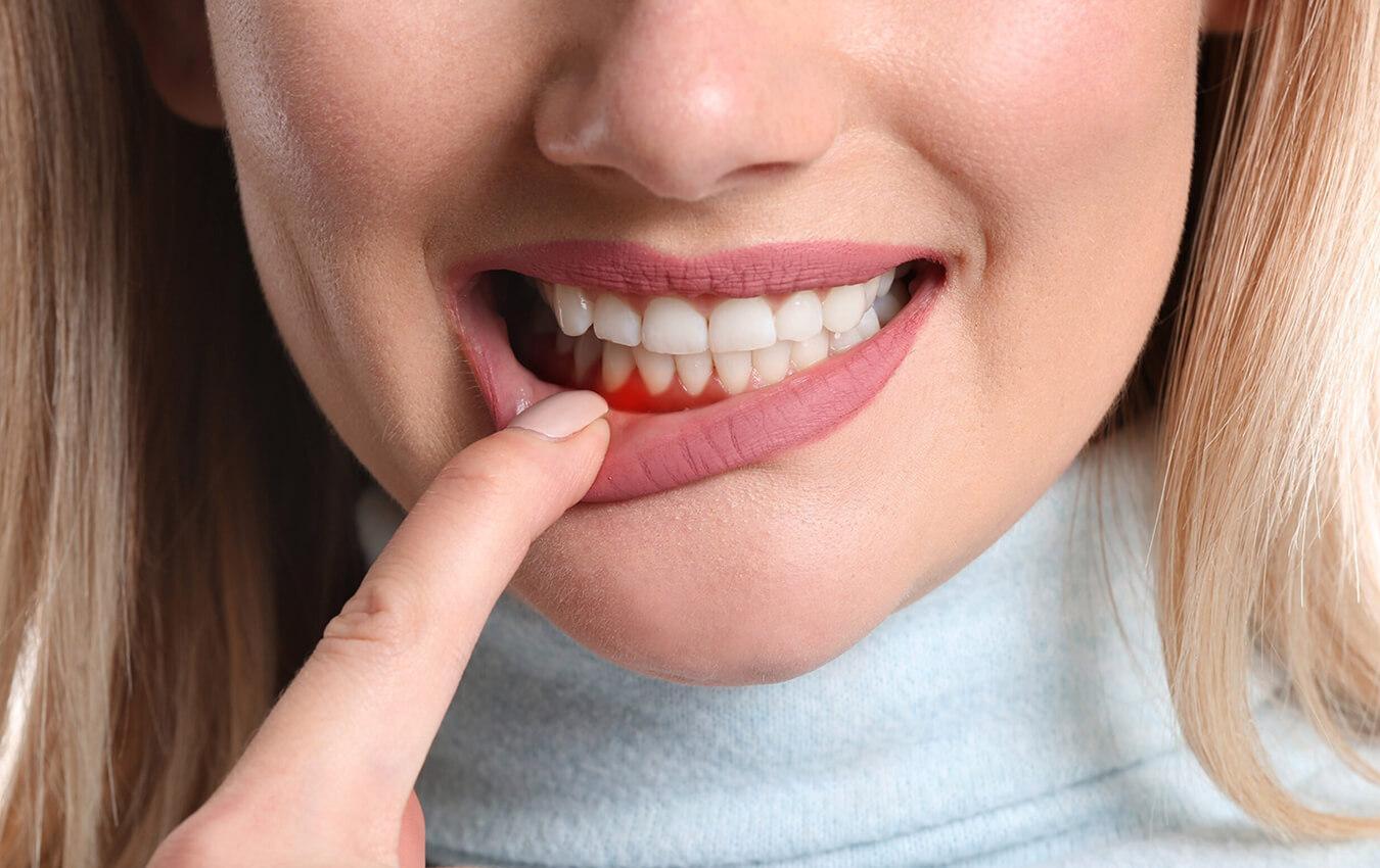 Gum Disease