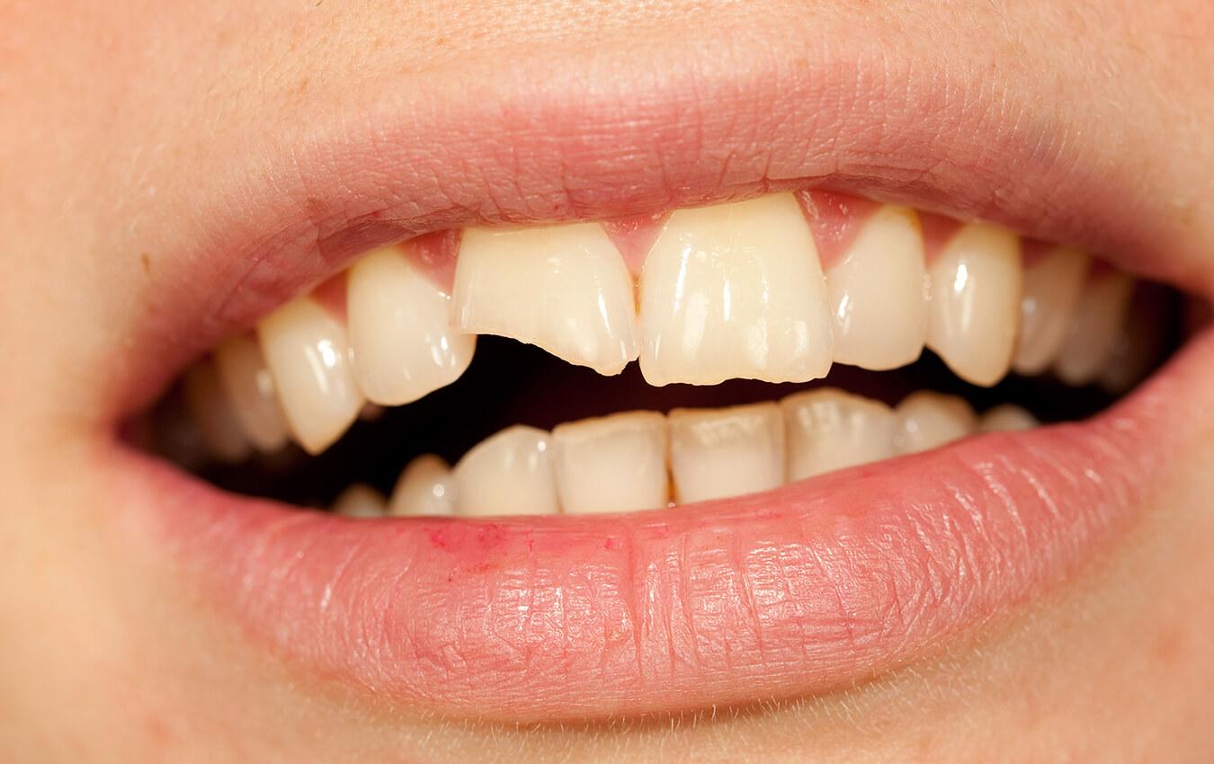 Help! I Cracked A Tooth