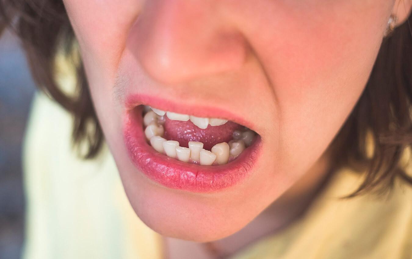 I Hate My Crooked Tooth