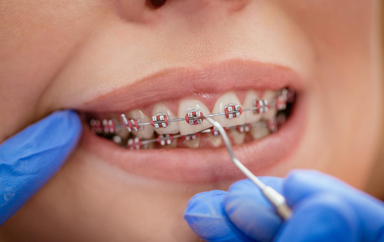 Orthodontic Treatment