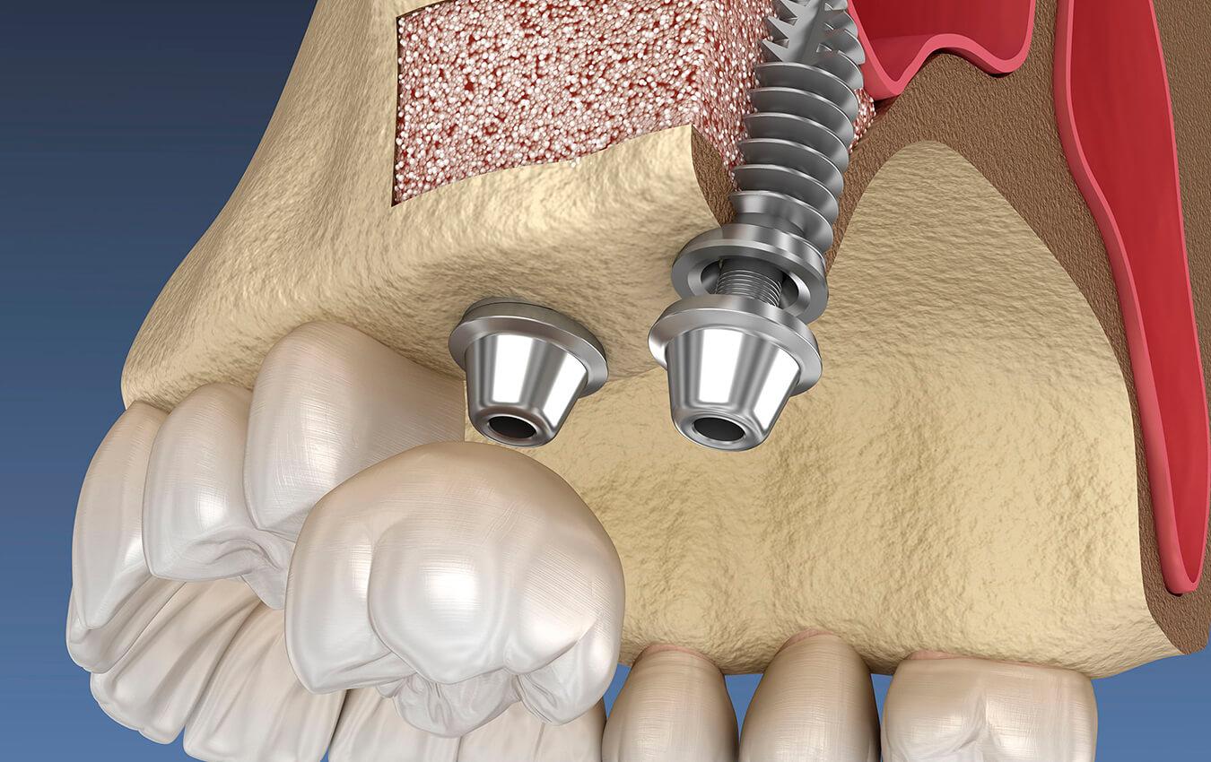 Sinus Lift
