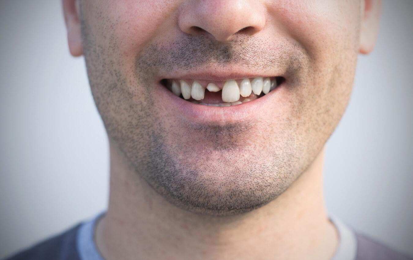 Sports and Tooth Injuries