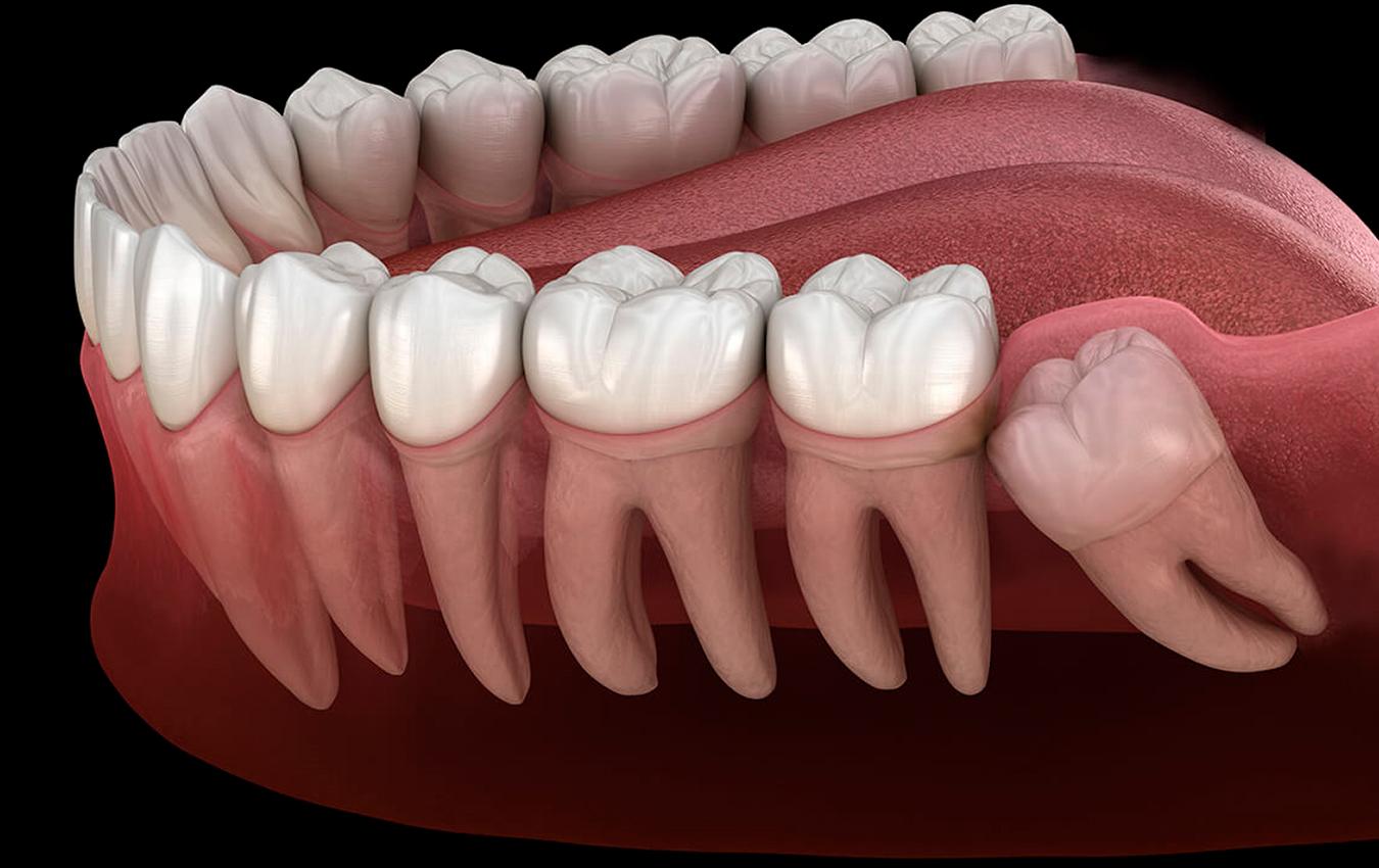 The Wisdom Tooth