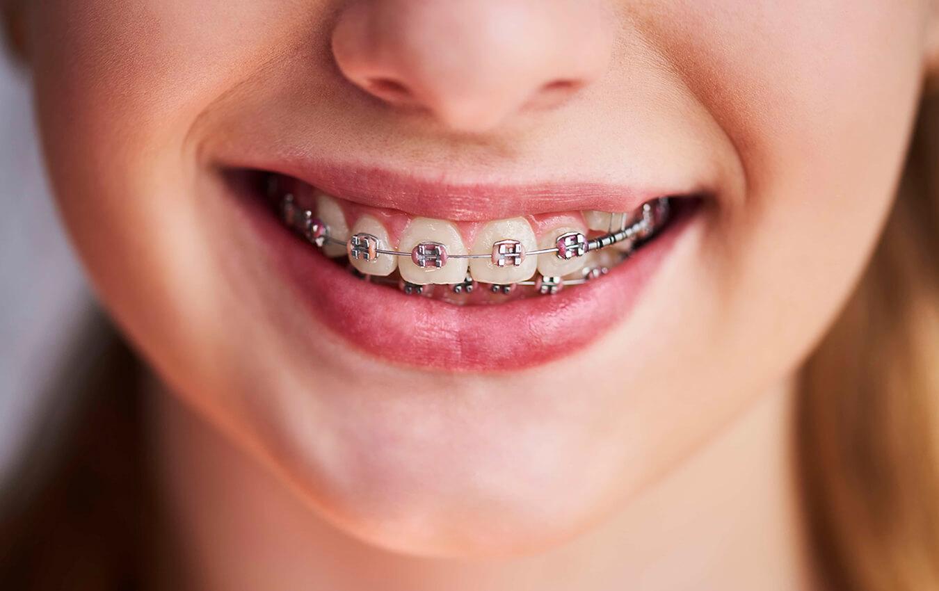 Tips To Stay Cavity-Free While Wearing Braces