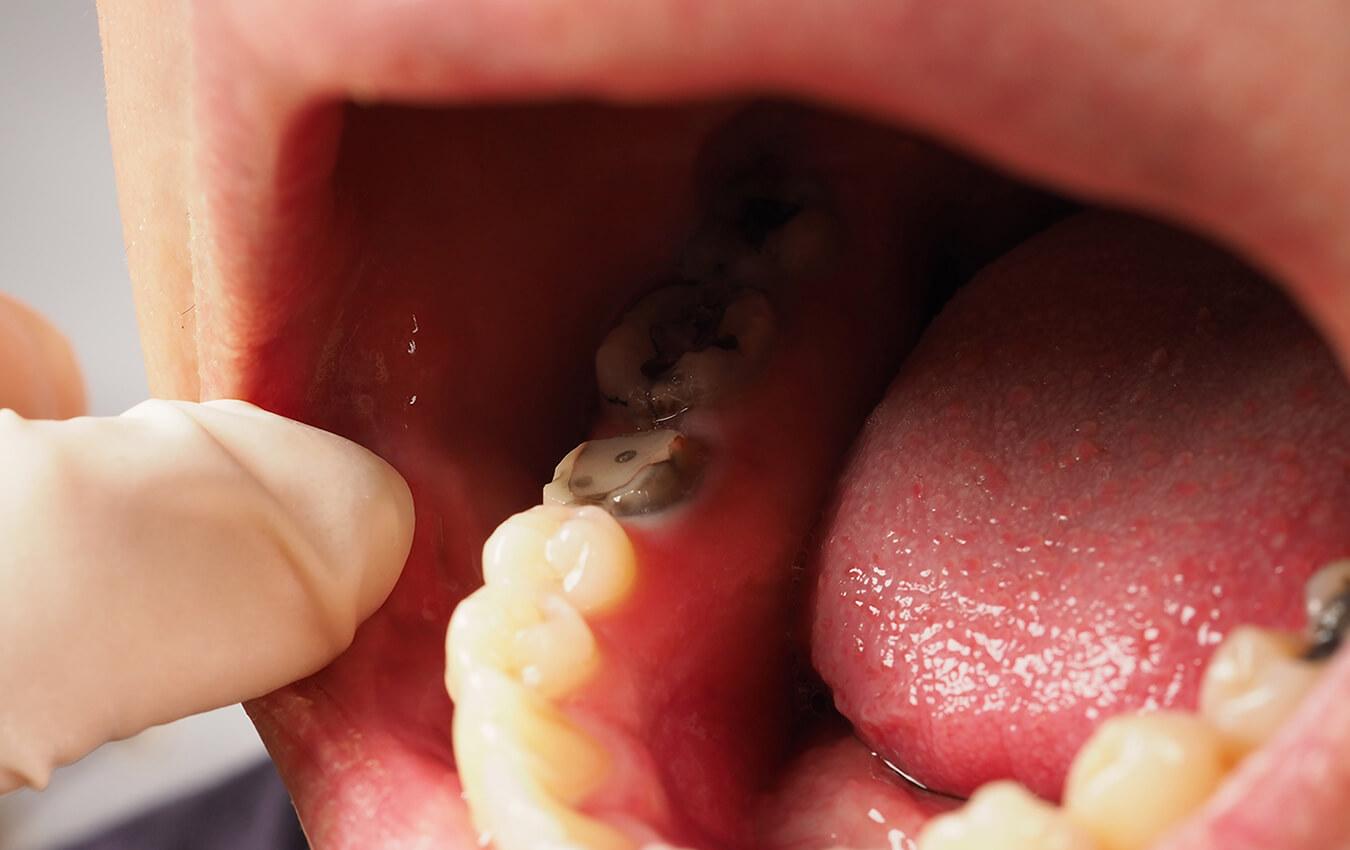 Tuberosity Reduction