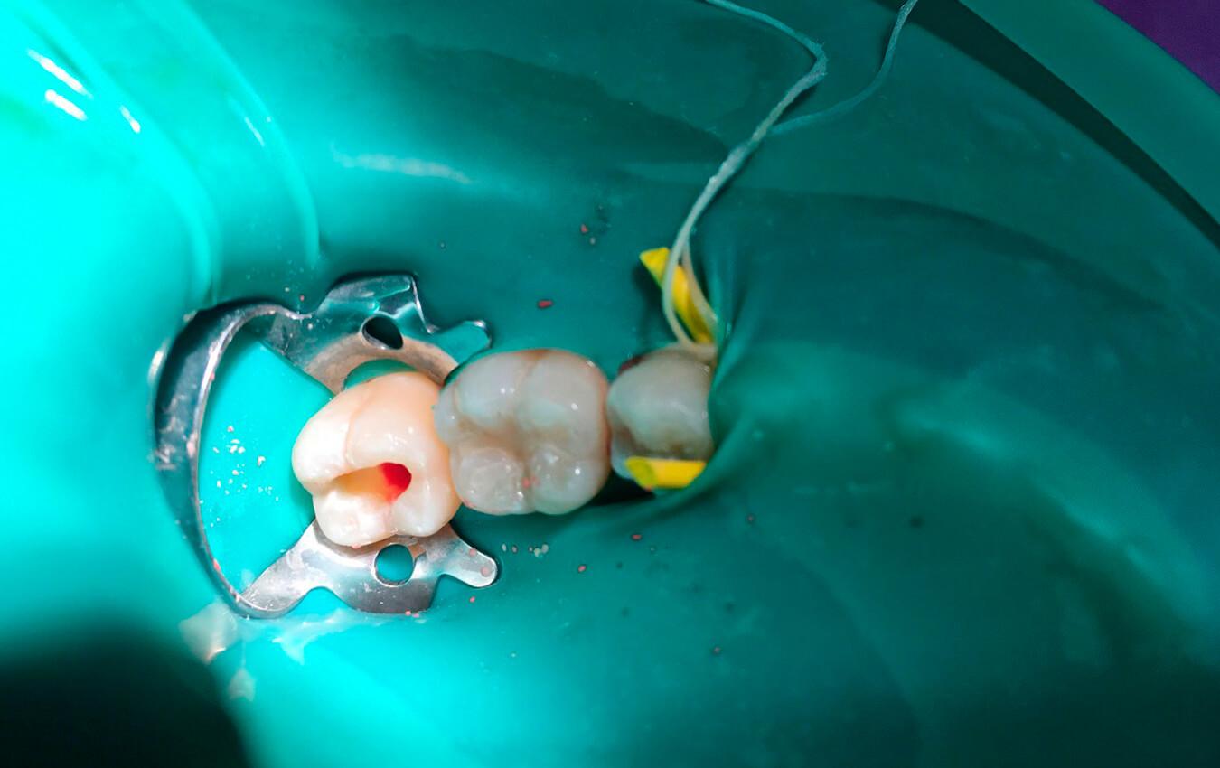 Vital Pulpotomy