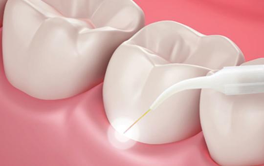 Non-Surgical Gum Treatment-3