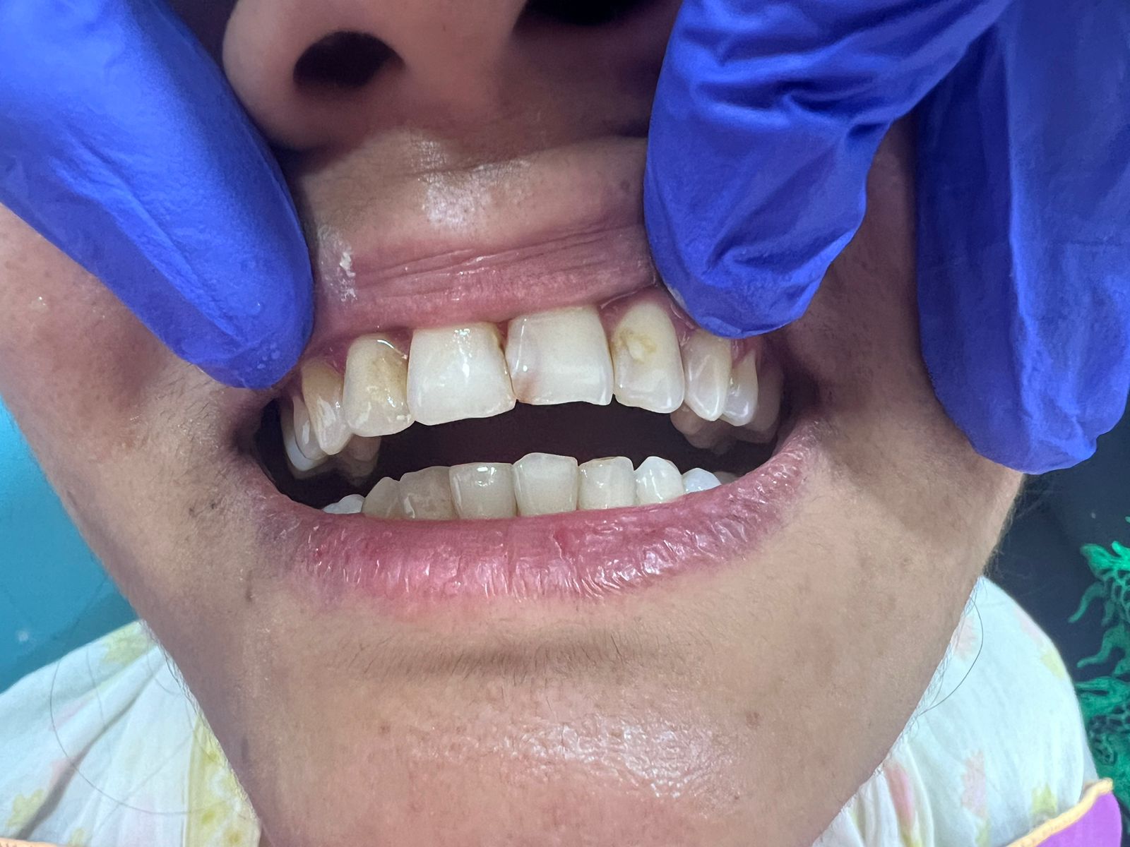 7 Common Cosmetic Dental Procedures and Their benefits