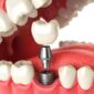 Dental Implants 768x484 1 85x85